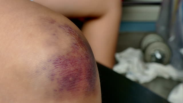 4K-dolly-girl-get-bruise-on-knee