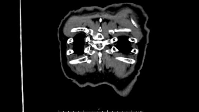 CTA)-der-thorakalen-Aorta-3D-Rendering-Bild.
