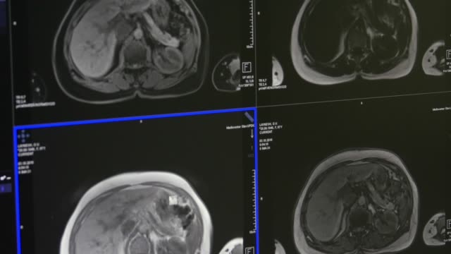 Tomografía-de-cerebro-en-MRI-exploración-equipo-médico-profesional.