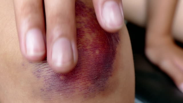 4K-dolly-girl-get-bruise-on-knee