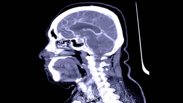 La-angiografía-de-CT-del-cerebro-en-el-plano-sagital-muestra-anatómica-del-cerebro.