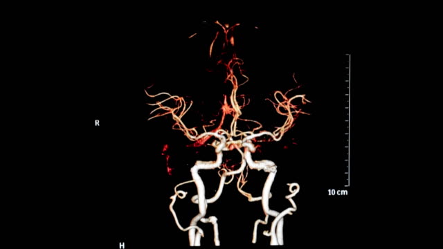 Computertomographie-Angiographie-oder-CTA-des-Gehirns-3D-Rendering-Bildes-zeigen-Schiff-des-Gehirns-auf-dem-Bildschirm-drehen.