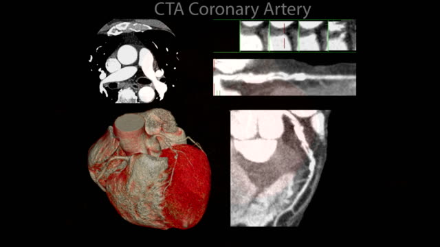 CTA-Coronary-artery--3D-rendering-image-of-the-realistic-heart-for-finding-heart-disease-.