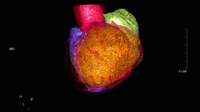 CTA-koronaren-Arterie-3D-Rendering-Bild-der-bunten-Herzen-für-die-Suche-nach-Herz-Kreislauferkrankungen.