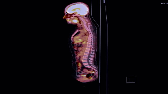 PET-CT-Bild-des-ganzen-Körpers-in-Sagittalebene.-Positronen-Emissions-Tomographie---Computertomographie.