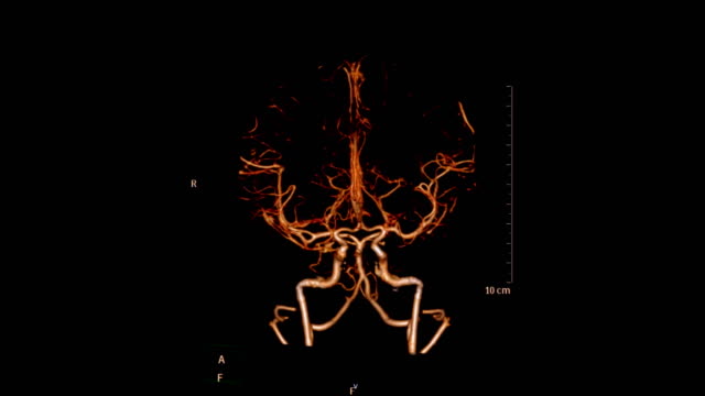 Angiografía-de-CT-del-cerebro-o-cerebro-de-cta,-procesamiento-de-imagen-3D.