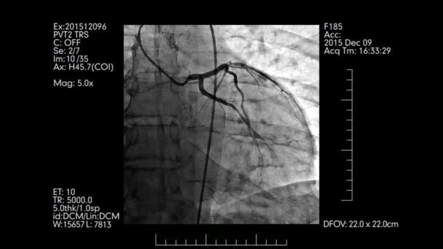 Koronarangiographie-Monitor-|-Herz-Kreislauf-Angiogramm