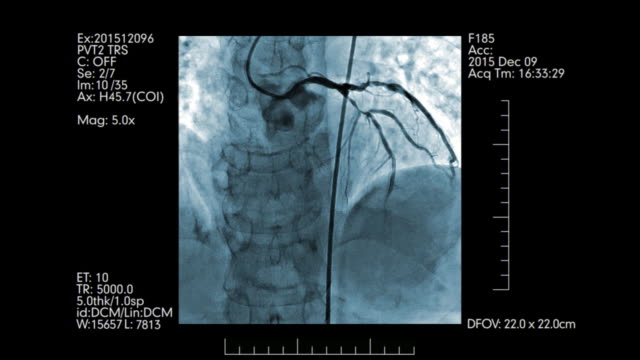 La-angiografía-de-la-prueba-de-los-vasos-del-corazón-azul-color