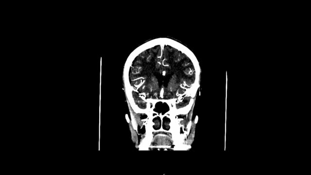 Angiografía-de-la-tomografía-computarizada-del-cerebro.