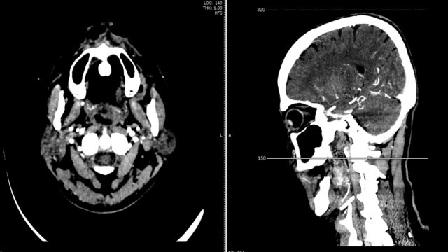 CT-SCAN-angiography-of-the-brain-with-contrast-media-,-Axial-and-sagittal-View-,-3D-rendering-image.