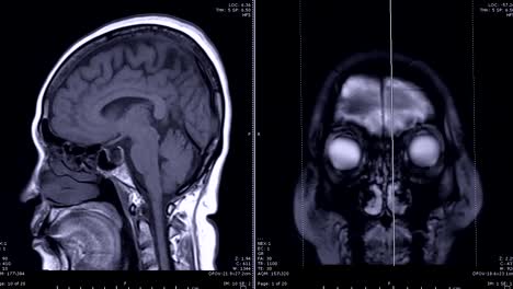 Magnetresonanztomographie-(MRT)-des-Gehirns-in-der-Sagittalebene-und-koronale-Fläche-mit-Kontrastmittel-Gadolinium.