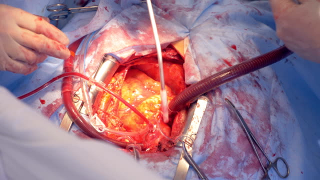 Process-of-a-heart-surgery-during-which-it-is-being-adjusted