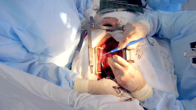 Vaskuläre-Verfahren-wird-bei-einem-Patienten-mit-aufgeschnittenen-Brust-durchgeführt