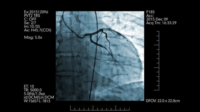 Digitale-Überwachung-der-Herzgefäße-|-Herz-Kreislauf-Angiogramm