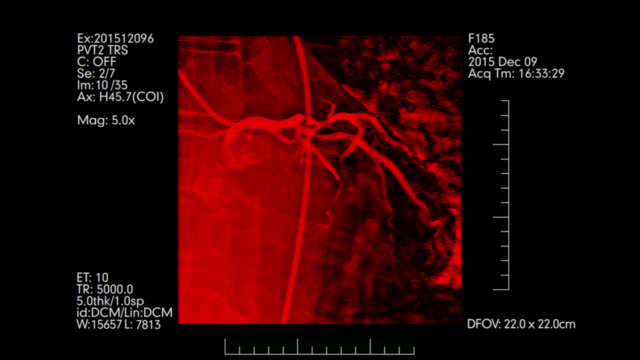 Red-colored-Heart-vessels-angiography-testing-display