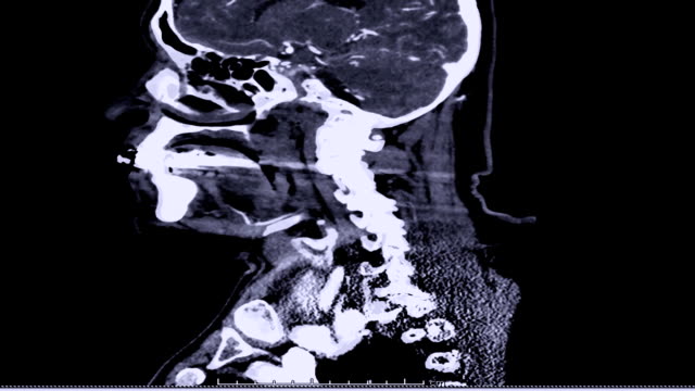 CT-Angiographie-des-Halses,-Sagittalebene.