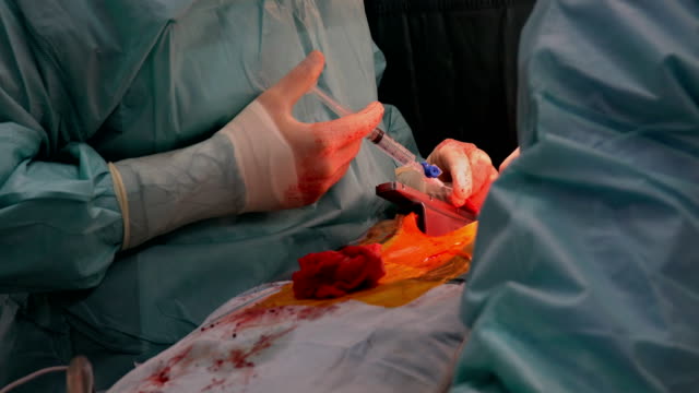 Proceso-de-la-cirugía-de-corazón-abierto,-para-reiniciar-el-corazón-después-de-cirugía-a-corazón-abierto