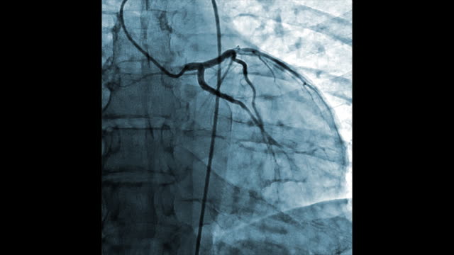 Medizinische-Überwachung-der-Herzgefäße-|-Herz-Kreislauf-Angiogramm