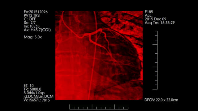 Rot-gefärbten-Angiogramm-der-Herzgefäße-|-Herz-Kreislauf-Angiographie