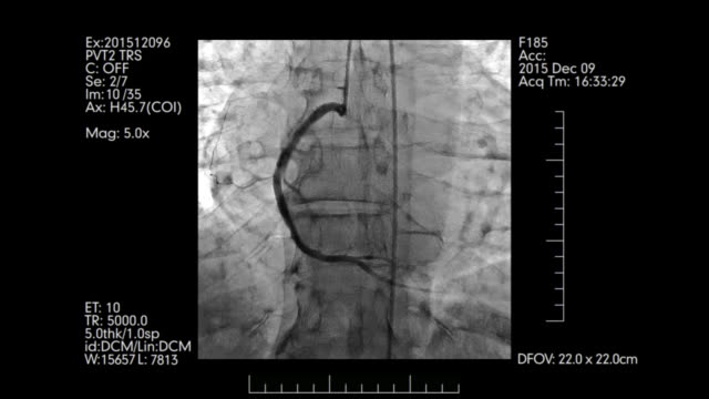 Angiografía-de-los-vasos-de-corazón-prueba-de-pantalla-con-la-información-médica