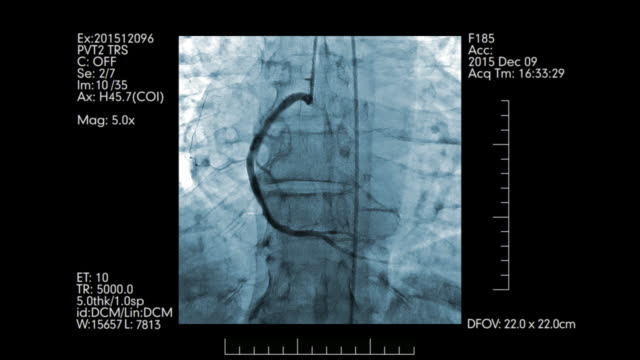 Azul-coloreada-angiografía-de-vasos-corazón-prueba-de-pantalla