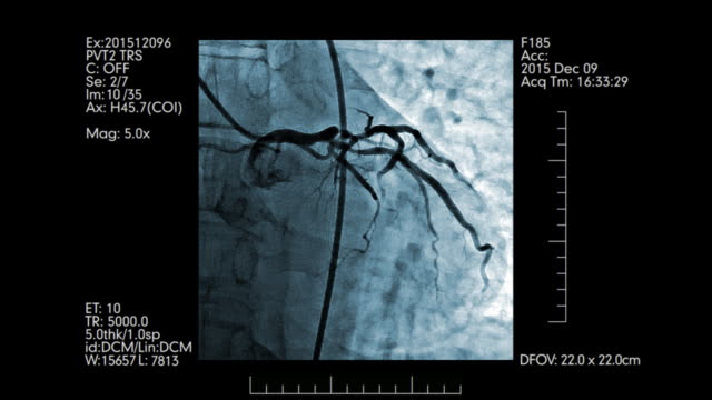 Angiography-testing-display.-Heart-vessels-monitoring