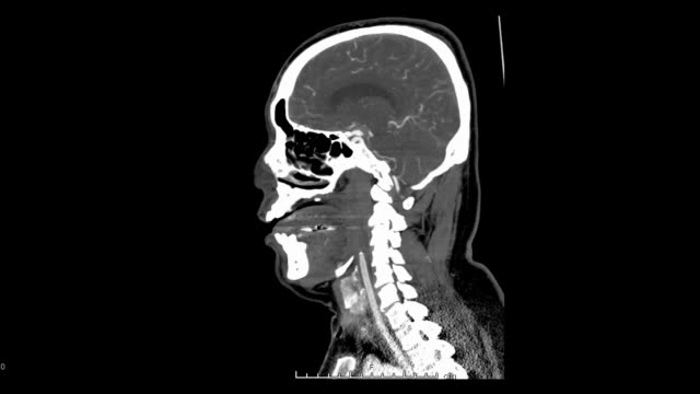 CT-Angiographie-an-Kopf-und-Hals.