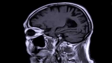 Magnetresonanztomographie-(MRT)-des-Gehirns-in-der-Sagittalebene.