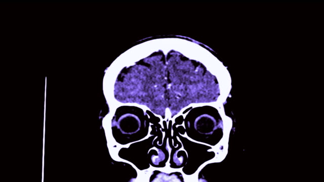 CTA-de-la-imagen-de-renderizado-3D-de-cerebro-en-plano-coronal.
