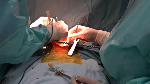 Cardiac-surgery.-Real-heart-beating-during-real-surgery.