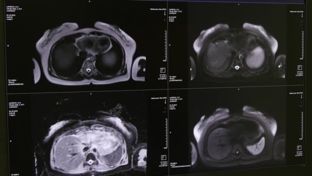 Tomografía-de-cerebro-en-la-exploración-de-MRI.
