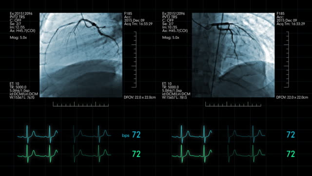 Cardiovascular-angiogram-with-heart-rate-monitoring-display