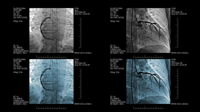 Visualización-médica-con-cuatro-angiogramas-coronarios-en-él