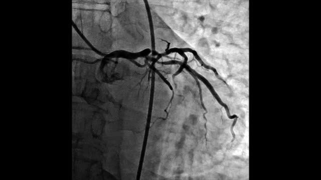 Heart-vessels-angiogram