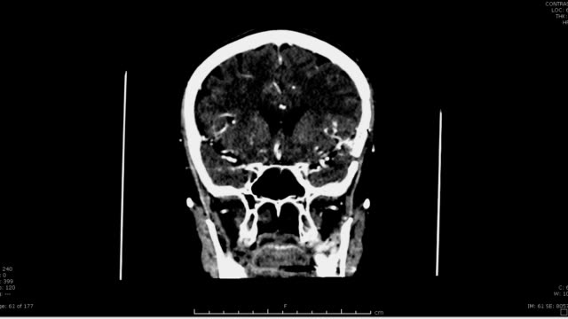 Ct-scan-of-the-brain-with-contrast-media.