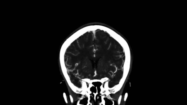 CTA-cerebral-o-angiografía-tomográfica-computada-de-la-vista-coronal-de-cerebro-/-3D-Rendering-buques-de-proyección-de-imagen-en-cerebro-humano.