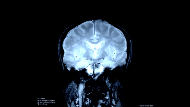 Gehirn-Scan-Bild