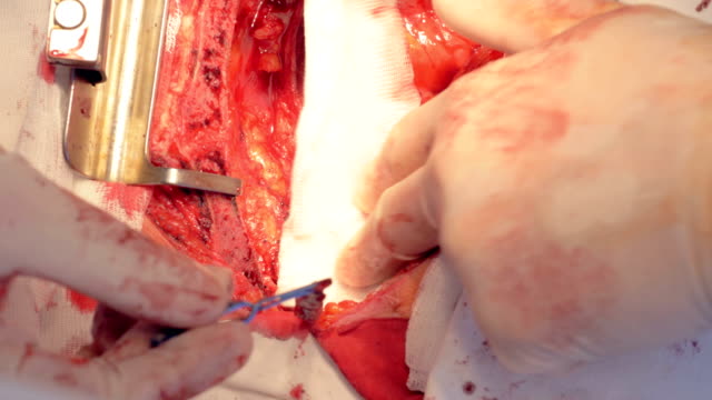 A-vessel-is-being-separated-and-laid-down-to-a-piece-of-gauze-during-an-open-heart-surgery