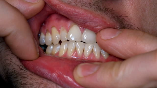 ein-Mann-zeigt-seine-Zähne-verbreiten-seine-Finger-Lippen,-Nahaufnahme