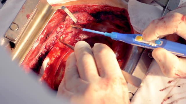 Close-up-of-a-cardiovascular-surgery-process