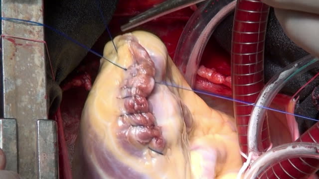 Heart-with-surgical-thread-on-live-organ-of-patient-during-operation-in-clinic.