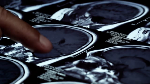 Arzt-Hand-zeigt-auf-Röntgenbild-des-Gehirns,-Dolly-erschossen-hautnah