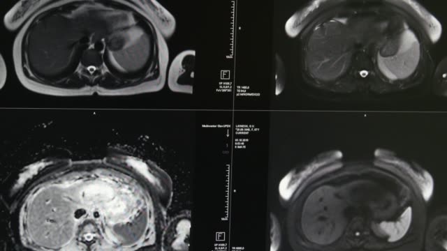 Brain-tomography-on-MRI-scan.