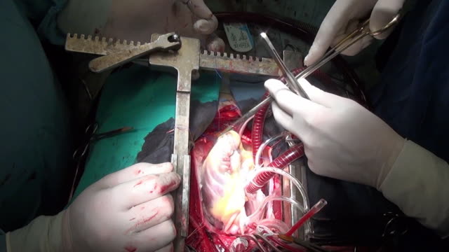 Herz-mit-dem-chirurgischen-Faden-live-Organ-des-Patienten-während-des-Betriebs-in-Klinik.
