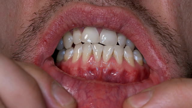 ein-Mann-zeigt-seine-Zähne-verbreiten-seine-Finger-Lippen,-Nahaufnahme