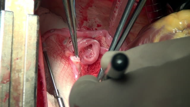 Corazón-con-hilo-quirúrgico-de-órgano-vivo-de-la-paciente-durante-la-operación-en-la-clínica.