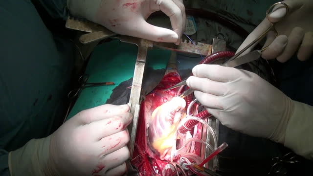 Corazón-con-hilo-quirúrgico-durante-la-operación-de-órgano-vivo-de-paciente-en-clínica.
