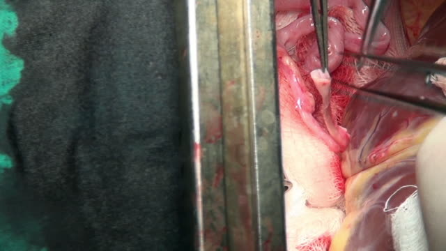 Heart-with-surgical-thread-on-live-organ-of-patient-during-operation-in-clinic.