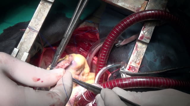Herz-mit-chirurgischen-Thread-während-des-Betriebs-auf-live-Orgel-der-Patient-in-der-Klinik.