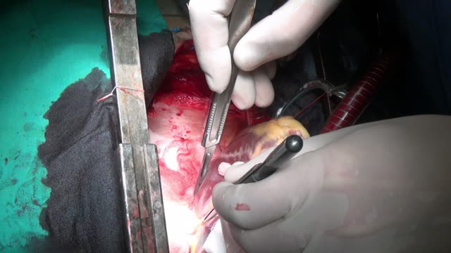Heart-surgery-on-live-organ-of-patient-in-hospital.
